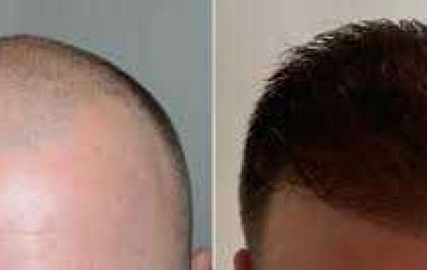 5. Healing Process and Itching of Hair transplant in Dubai UAE ?
