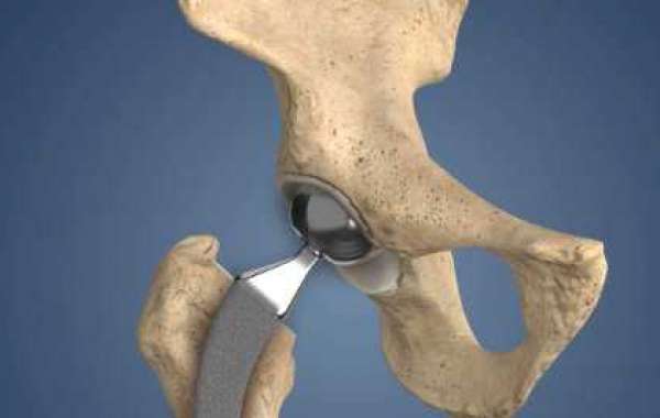 Hip Replacement is Estimated to Witness High Growth Owing to Rapid Increase in Osteoarthritis Cases
