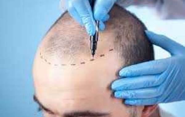 How expensive is a hair transplant?