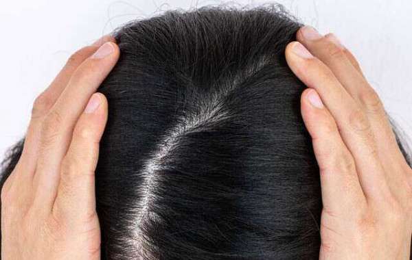 Exploring the World of Hair Transplant Tourism