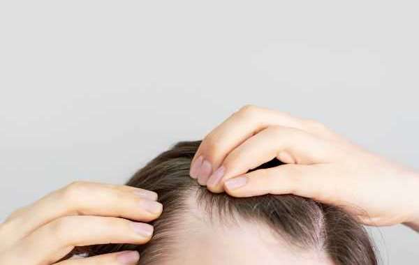 The Impact of Stress on Hair Loss and the Role of Transplantation