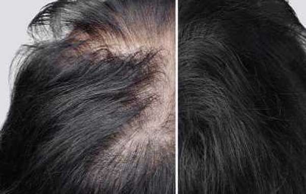 The Intensity of Hair Loss/Baldness | PRP in Dubai At Royal Clinic ?