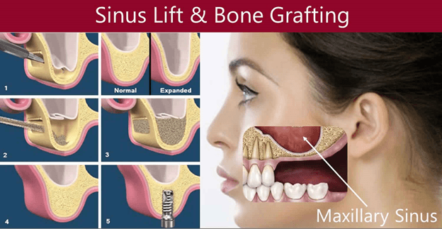Direct & Indirect Sinus Lift Surgery for Tooth implants Cost