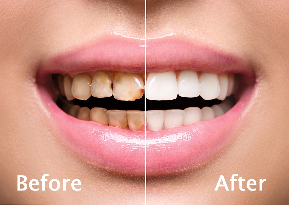 Teeth Scaling, Teeth Cleaning & Polishing, Dental Scaling Delhi