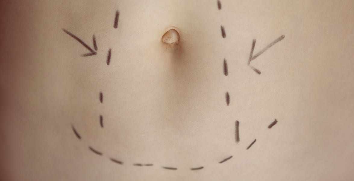 Learn Everything You Need to Know about Belly Button Plastic Surgery