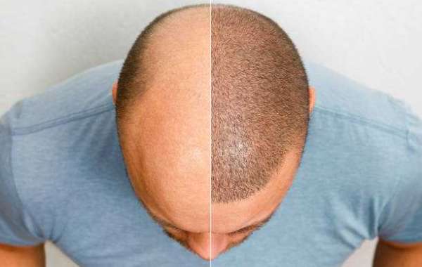 Hair Transplant Cost In Perth