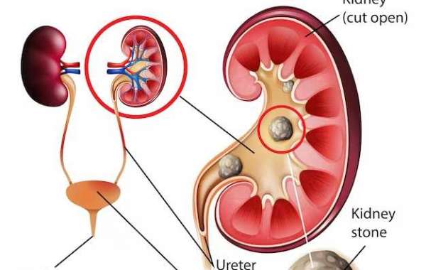 Kidney Stones in Older People – Ways to Prevent