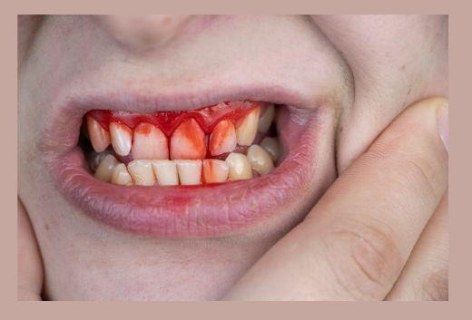 Signs You Should Be Concerned About Bleeding Gums