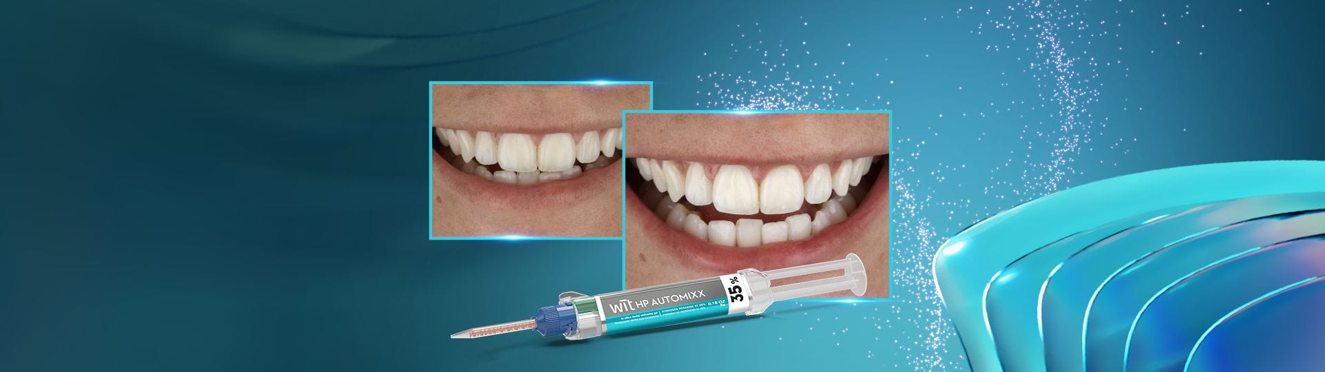 Tooth whitening in the office: a fast and effective alternative for immediate whitening - FGMUS