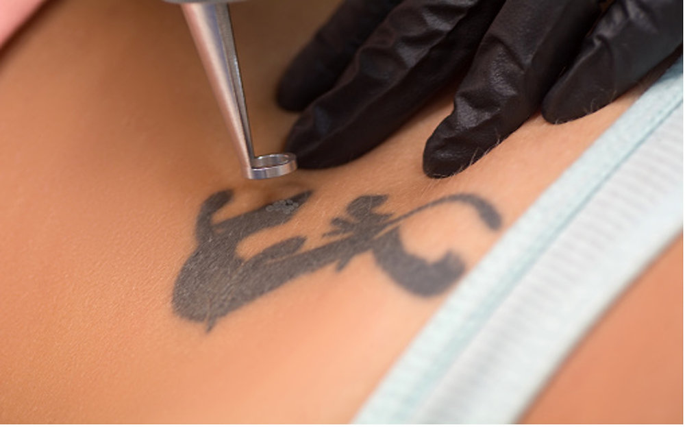 Laser Tattoo Removal: How it Works & All You Need to Know