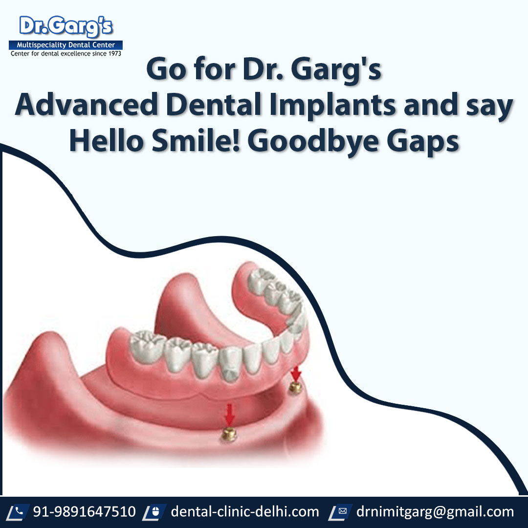 Go for Dr. Garg's Advanced Dental Implants and say Hello Smile! Goodbye Gaps