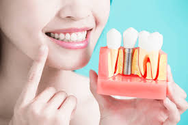 Factors That Influence the Cost of Dental Implants | TheAmberPost