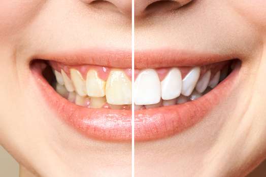 Teeth Whitening Near Me, Zoom Whitening in Delhi