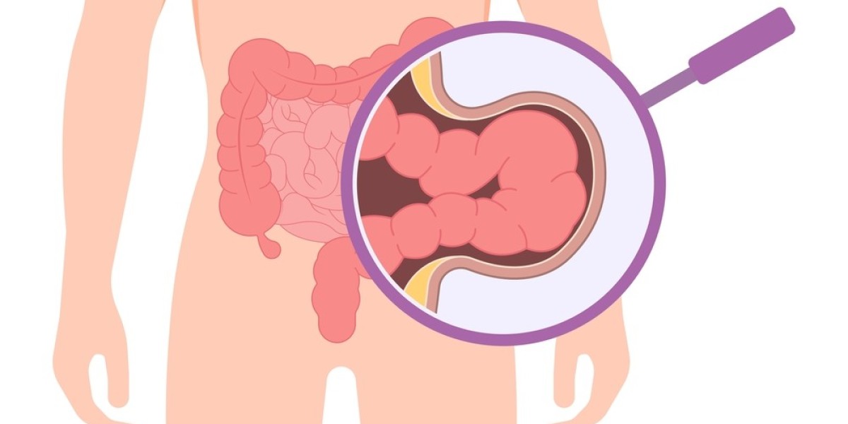 Which Surgery is Best for Umbilical Hernia