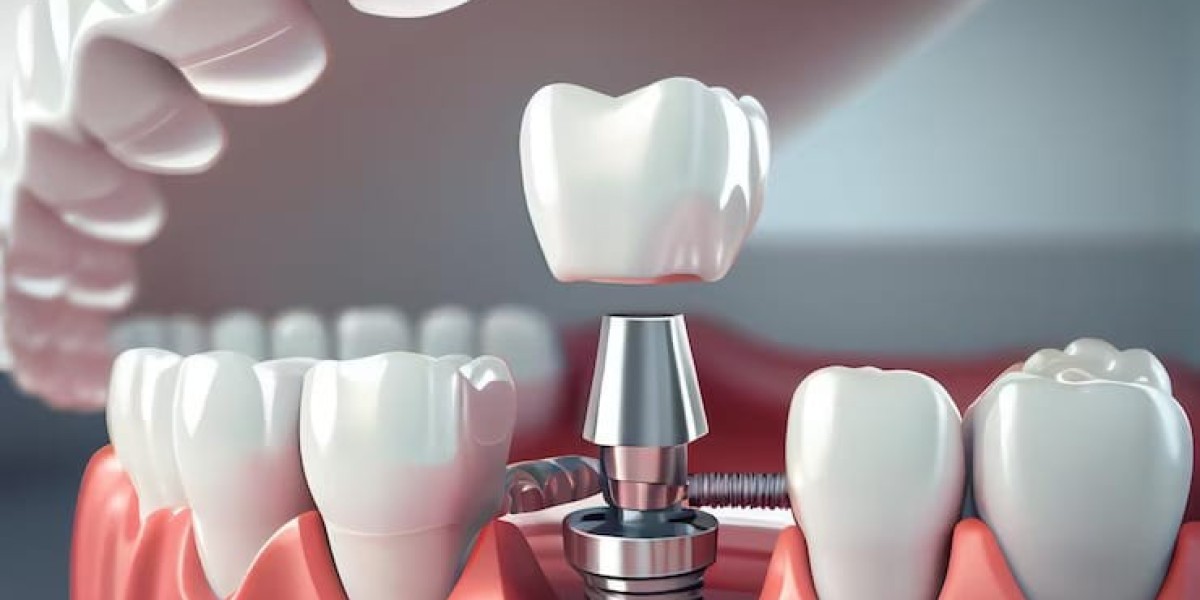 Is a Dental Implant the Right Choice for You? Find Out Now!