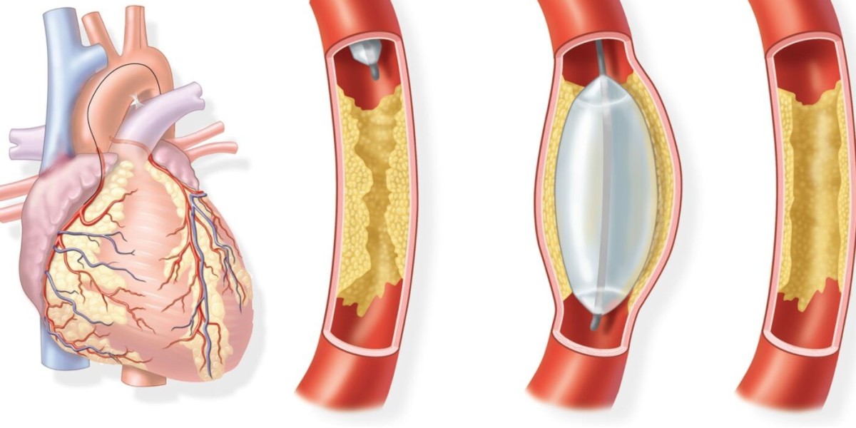 Coronary Artery Bypass Grafting: Lifesaving Procedure for Heart Disease