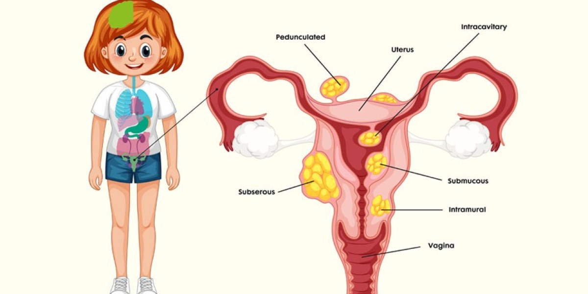 Effective Uterine Fibroids Treatment Options for Better Health