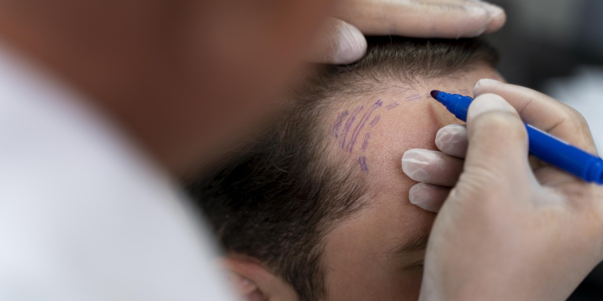 Get Natural-Looking Results with the Best Hair Transplant in NCR.