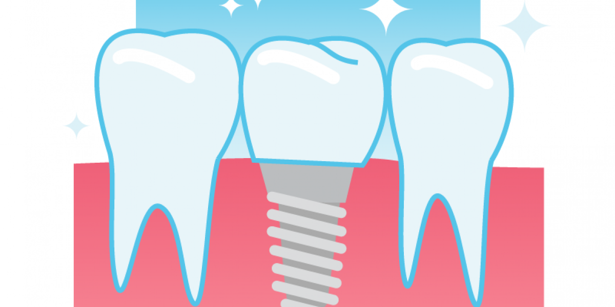 Local Dental Implants in Bartlett, TN | Bellano Dental Health