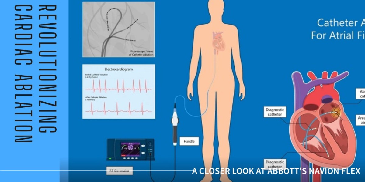 Abbott's Navion Flex Revolutionizes Cardiac Ablation: A Closer Look