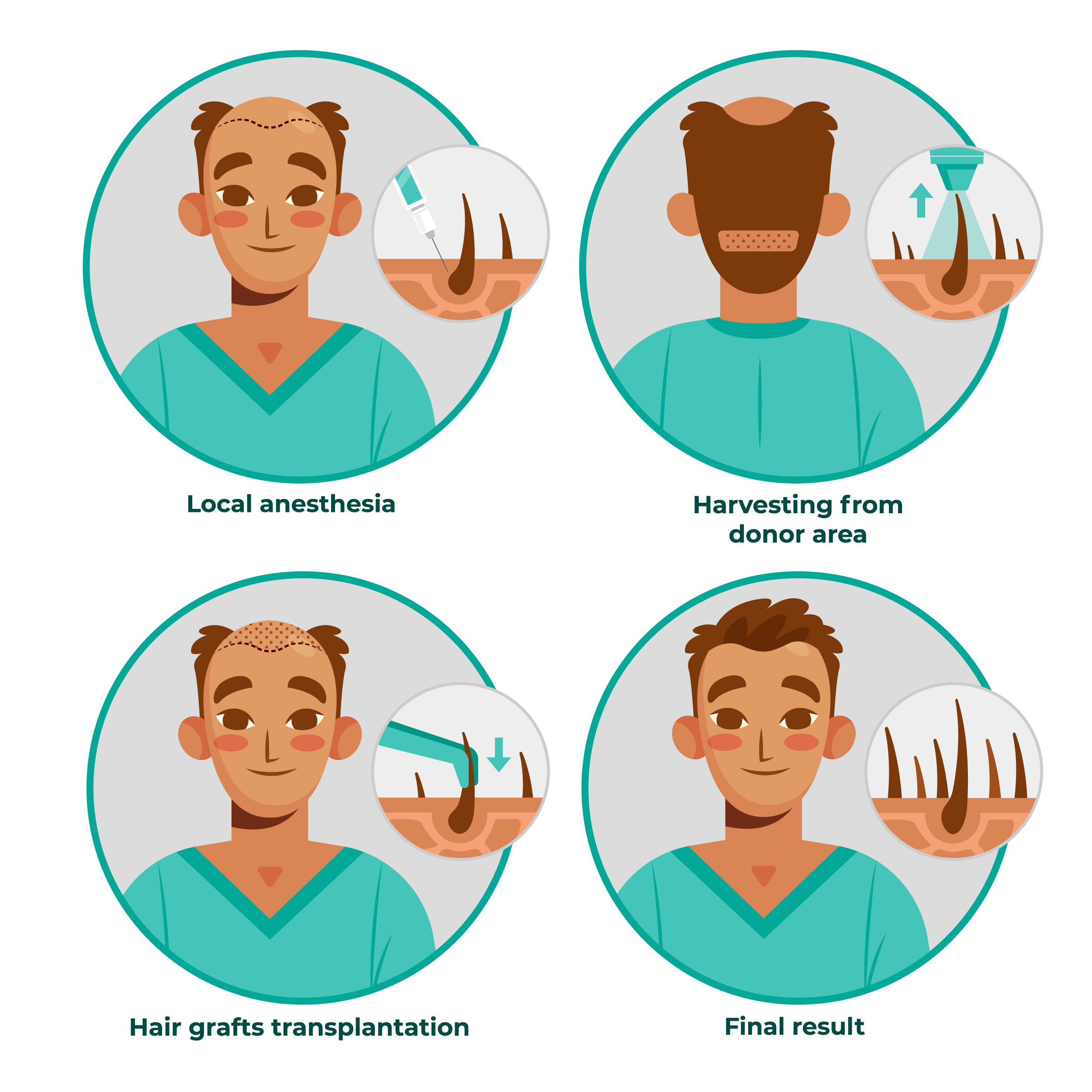 Hair Transplant in Kota | IFT Hair Science | Call Now