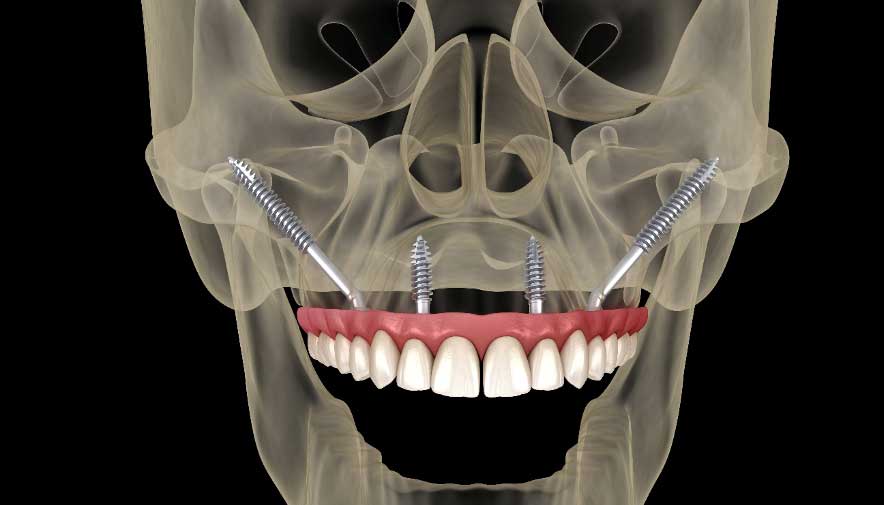 Implantes cigomáticos ¿Qué son? ¿Qué precio tienen?