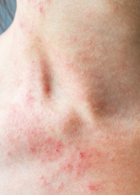 HOW TO TREAT YOUR ECZEMA HYPERPIGMENTATION ON THE BODY - Pharmaclinix