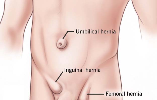 Hernia Surgery in Kolkata at Low Cost » Laparoscopic Hernia Treatment Doctor