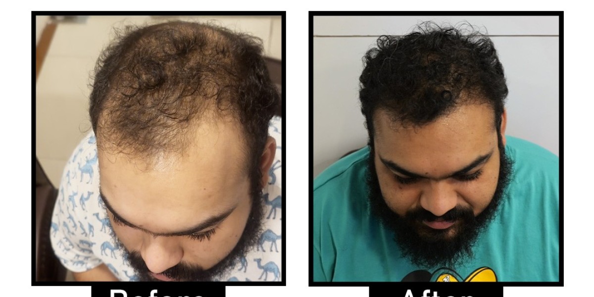 Affordable and Best Hair Transplant in South Delhi