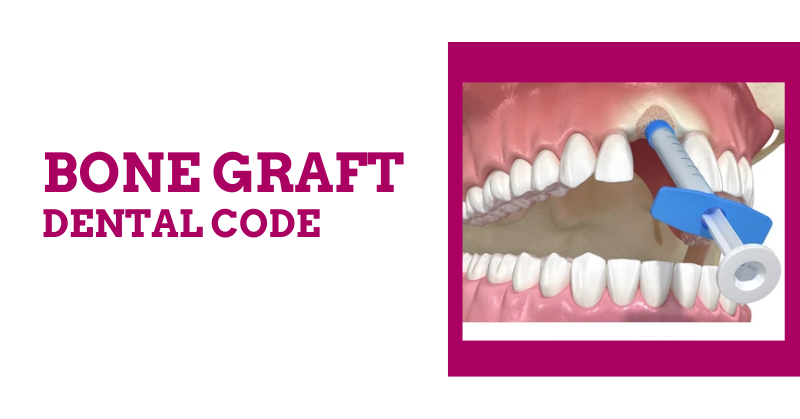 Best Guide to Understanding Bone Graft Dental Codes | 2024