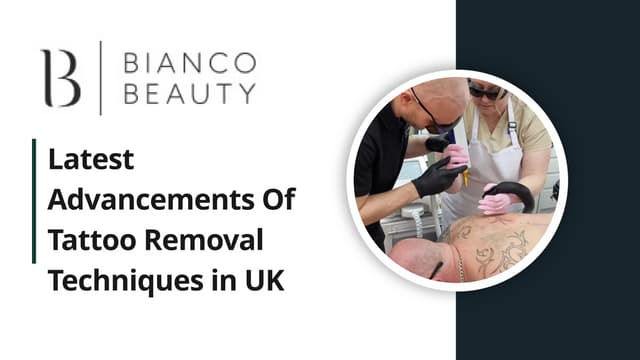 Latest Advancements Of Tattoo Removal Techniques in UK