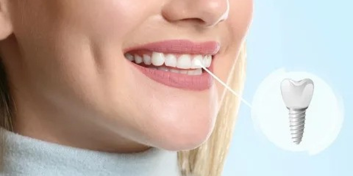 Transform Your Smile with Dental Implants and Professional Care from Benich Dental in Marietta, GA