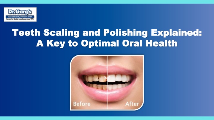 PPT - Teeth Scaling and Polishing Explained A Key to Optimal Oral Health PowerPoint Presentation - ID:13723966