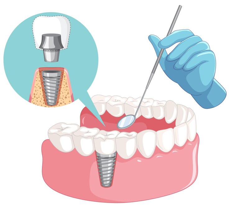 Dental Health Resolutions: Prioritizing Dental Checkups and Implants - Bioneers Live