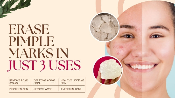 Erase Pimple Marks in Just 3 Uses       – Vedikroots