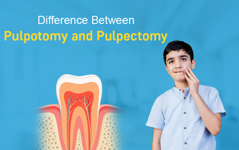 Pulpotomy vs. Pulpectomy: Key Differences Explained