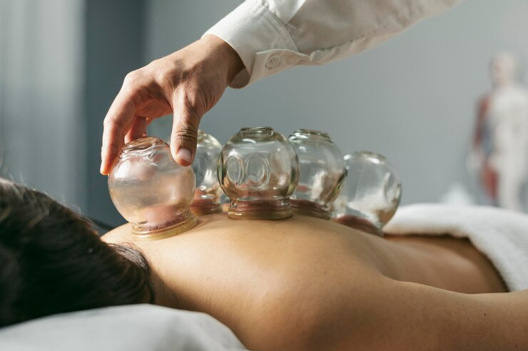 Cupping Therapy: Ancient Healing for Modern Wellness