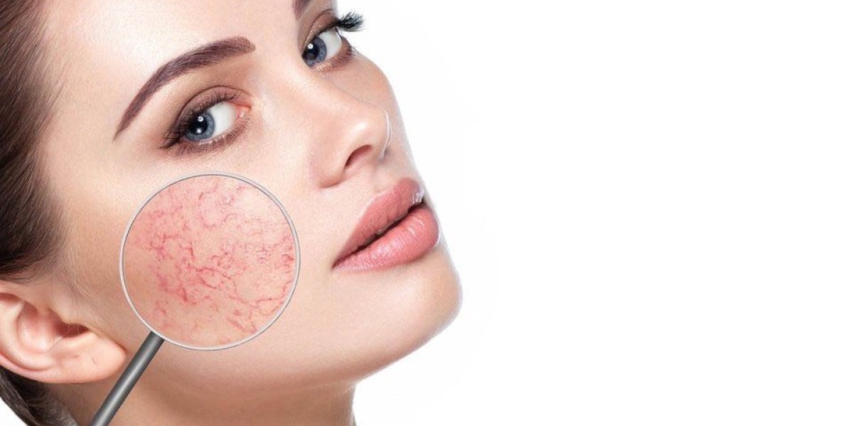 Rosacea Treatment Market: Abbott's new topical launch to boost Rosacea Treatment Market growth