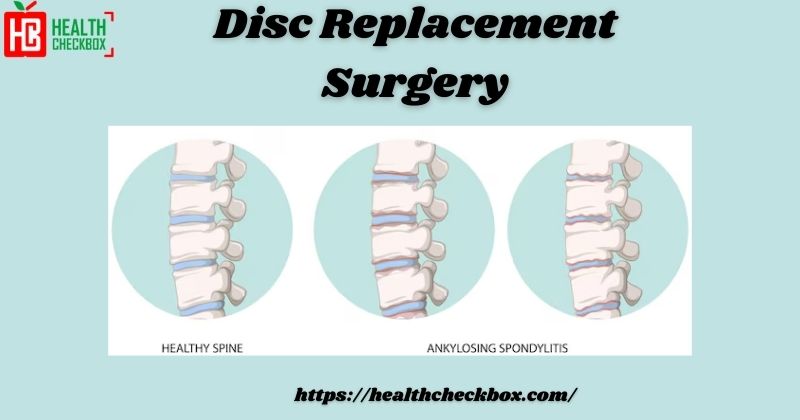 Disc Replacement:Understanding the Procedure,recovery & risk - A Medley of Random Thoughts & Articles