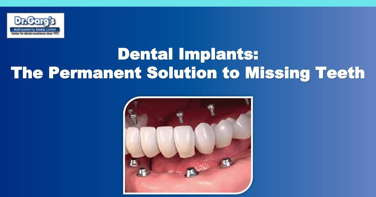 Dental Implants: The Permanent Solution to Missing Teeth