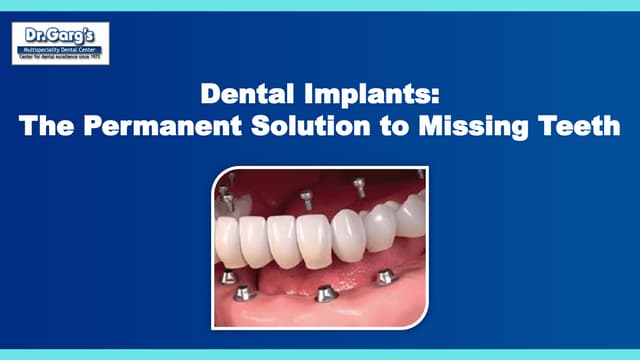 Dental Implants: The Permanent Solution to Missing Teeth