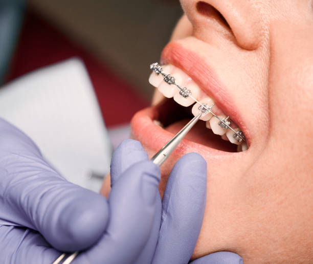 Transform Your Smile with Expert Braces Treatment in Superior: ascendorthodont — LiveJournal