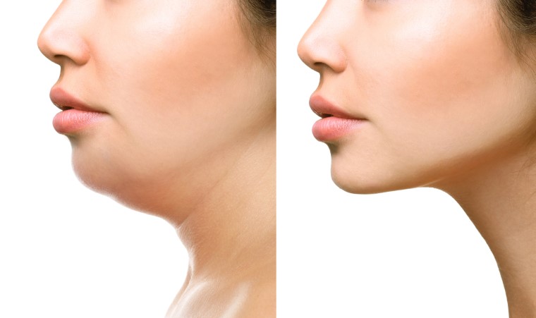 What Is The Best Procedure To Get Rid Of A Double Chin | My Cosmetic Clinic