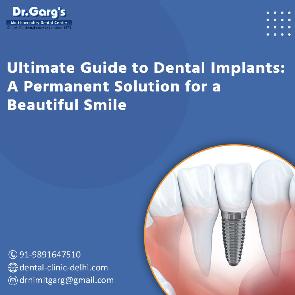 The Ultimate Guide to Dental Implants: A Permanent Solution for a Beautiful Smile