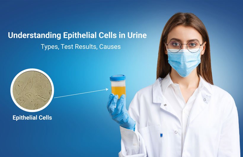 Epithelial Cells in Urine: Types, Causes, and Test Results