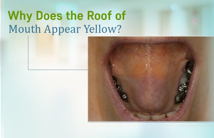 Why Is the Roof of My Mouth Yellow? Causes & Remedies