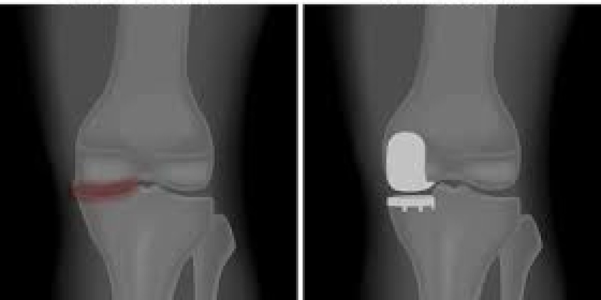 Knee Replacement Cost in India Book Appointment Online