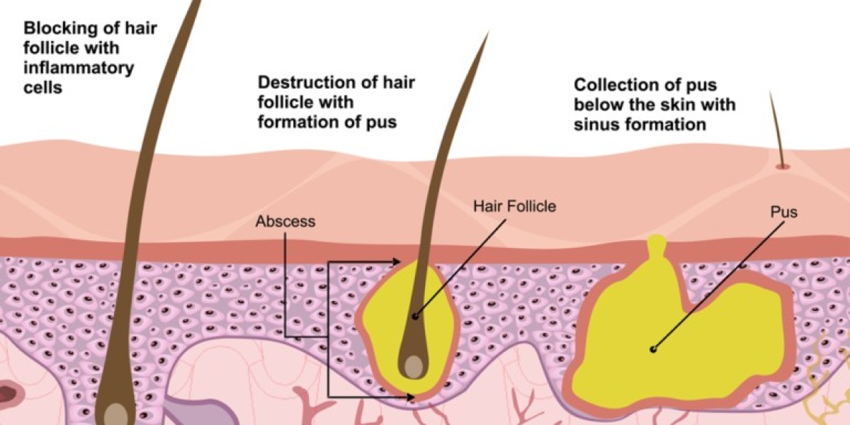 Hidradenitis Suppurativa treatment