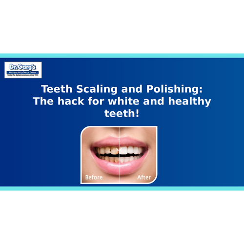 Teeth Scaling and Polishing: The hack for white and healthy teeth!