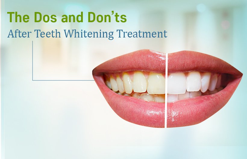 The Dos and Don’ts After Teeth Whitening Treatment